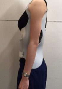 GBWLEFTnbsp| シュロスベストプラクティスジャパン | 最新の側弯症のシュロス式運動療法と装具をドイツから